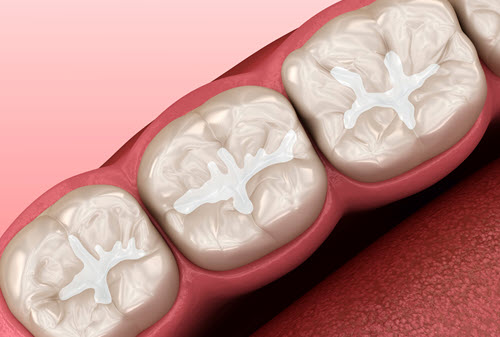 Composite Fillings