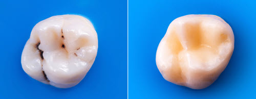 Composite Fillings