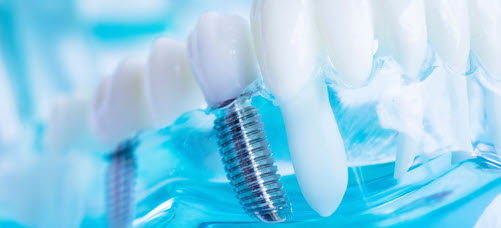 Dental Implants