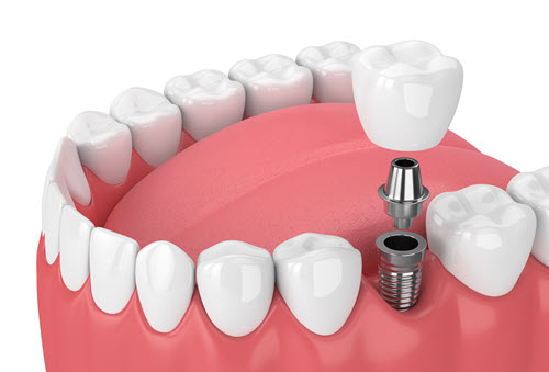 Dental Implants