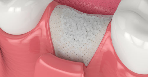 bone graft