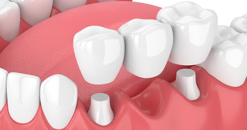 dental bridges