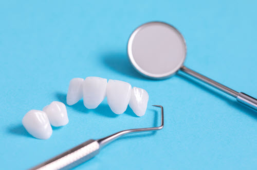 dental bridges