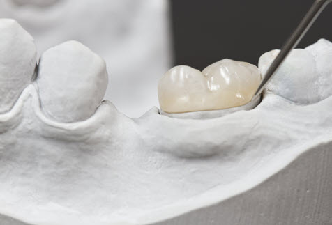 dental crowns