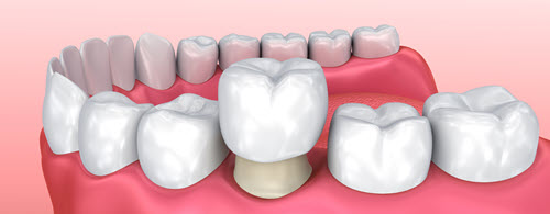 dental crowns