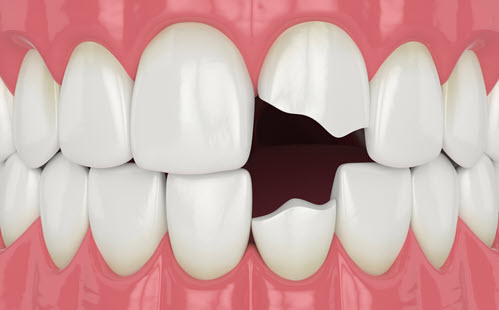 tooth restoration