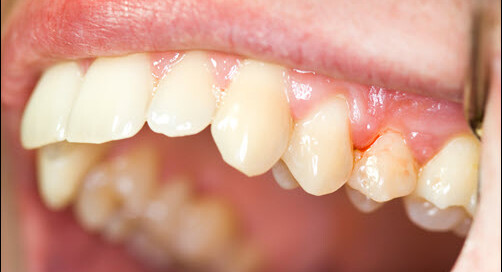 Gingivitis