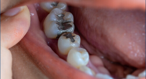 Dental Fillings