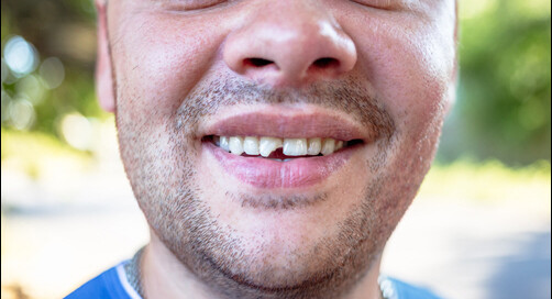 Damaged Teeth