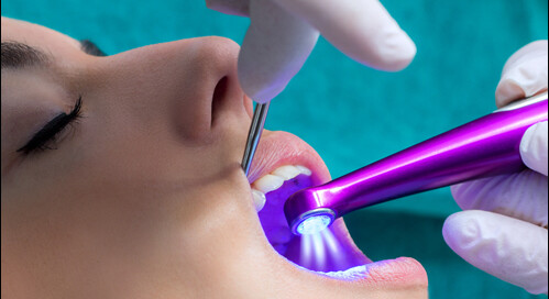 Dental Sealants