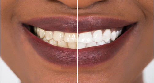 Whitening