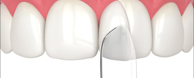 Dental Bonding
