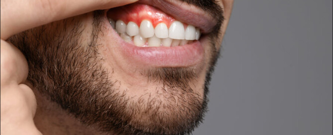 Gingivitis