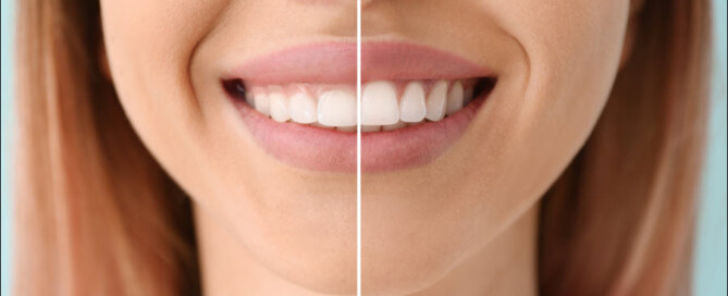 Gum Contouring