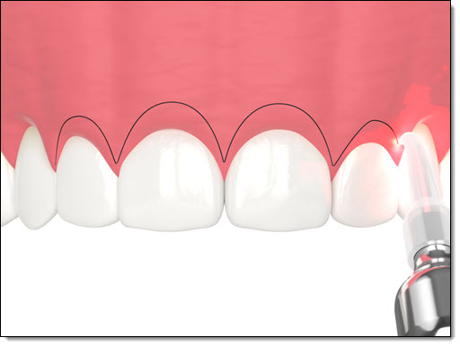 Gum Contouring