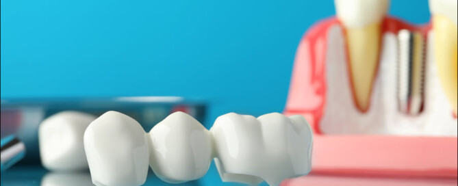 Dental Bridges